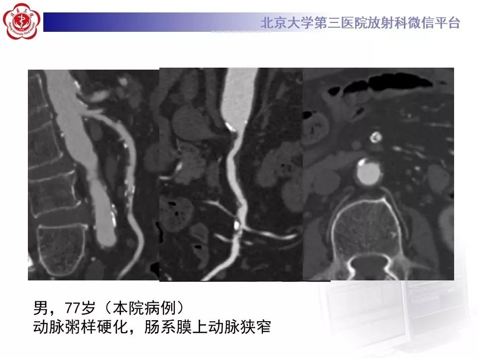 【PPT】肠系膜上动脉栓塞
