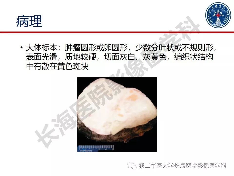 【PPT】纤维-卵泡膜细胞肿瘤影像诊断