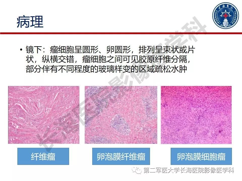 【PPT】纤维-卵泡膜细胞肿瘤影像诊断