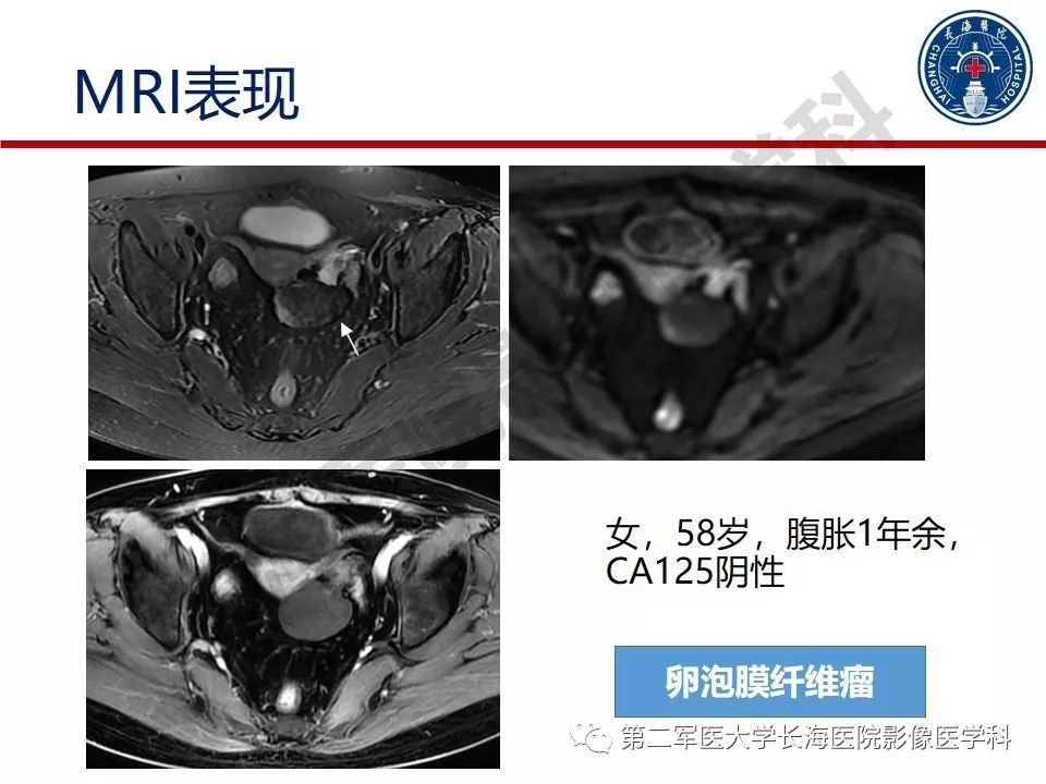【PPT】纤维-卵泡膜细胞肿瘤影像诊断