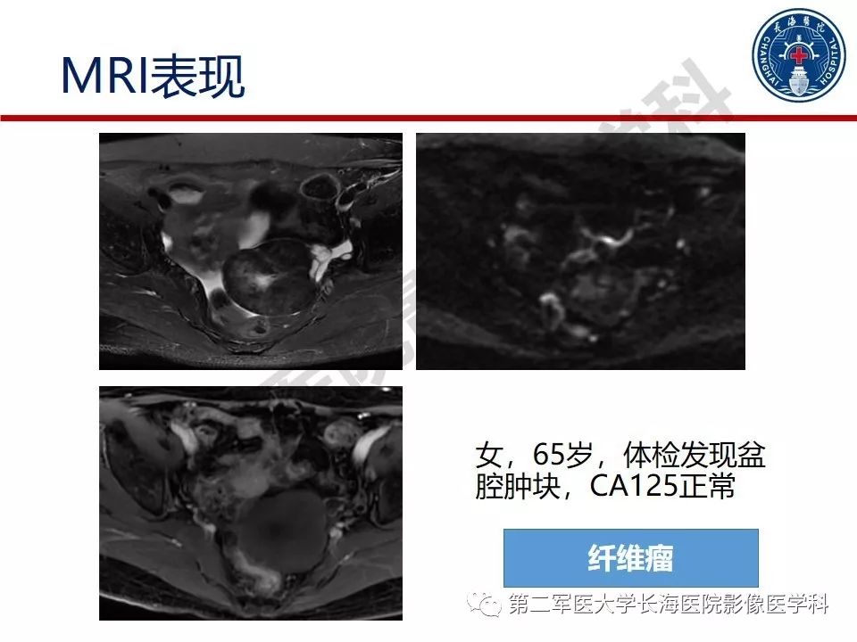 【PPT】纤维-卵泡膜细胞肿瘤影像诊断