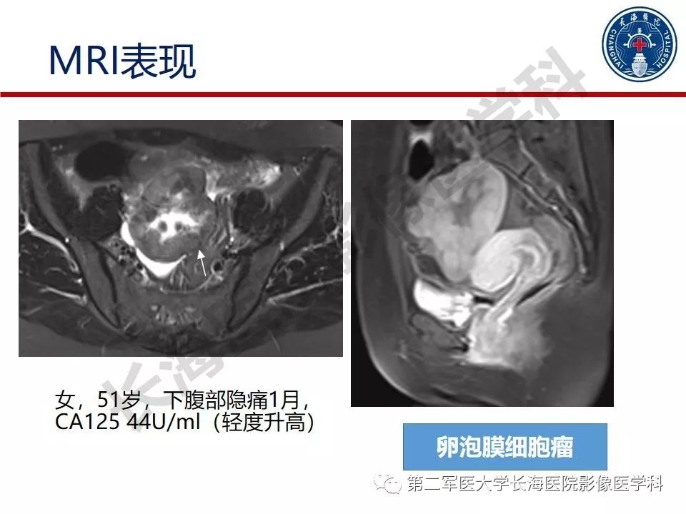 【PPT】纤维-卵泡膜细胞肿瘤影像诊断