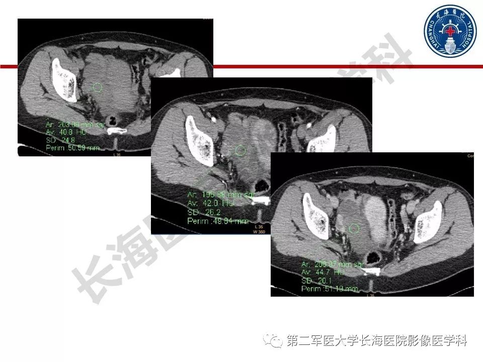 【PPT】纤维-卵泡膜细胞肿瘤影像诊断