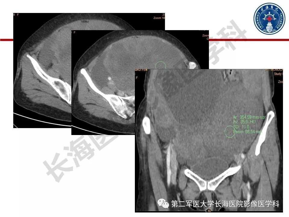 【PPT】纤维-卵泡膜细胞肿瘤影像诊断