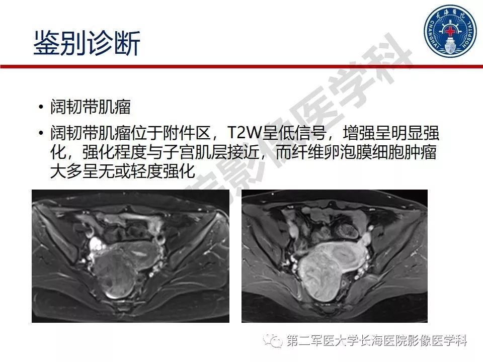 【PPT】纤维-卵泡膜细胞肿瘤影像诊断