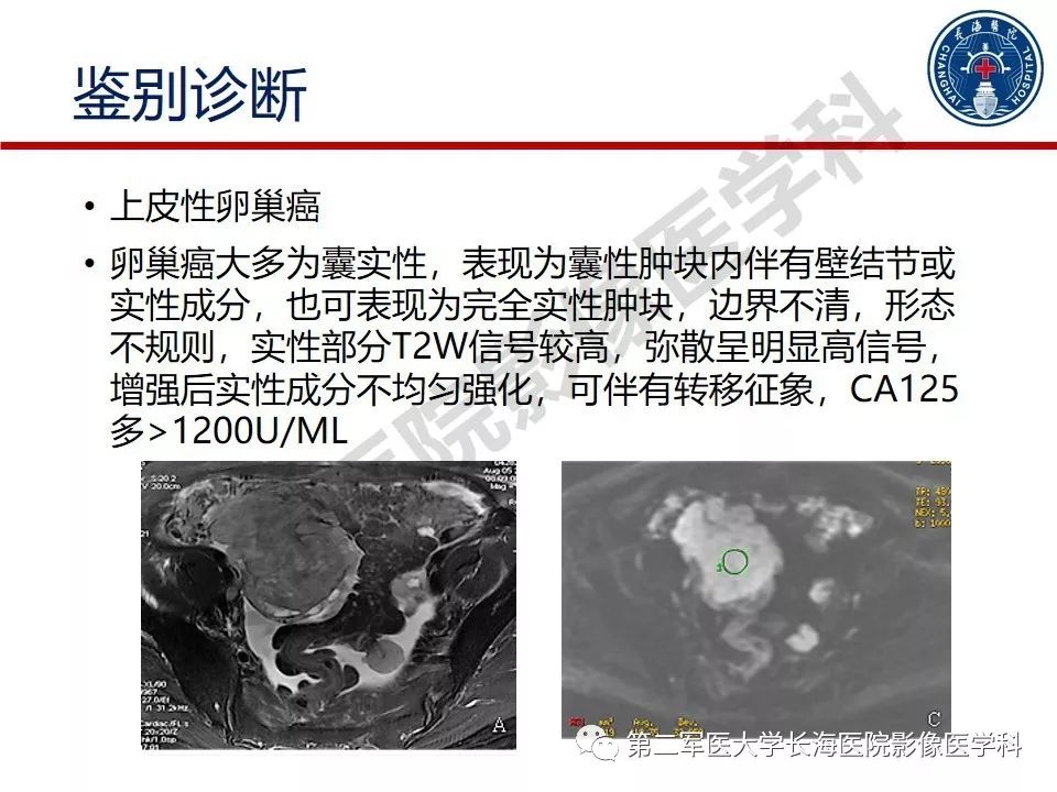 【PPT】纤维-卵泡膜细胞肿瘤影像诊断