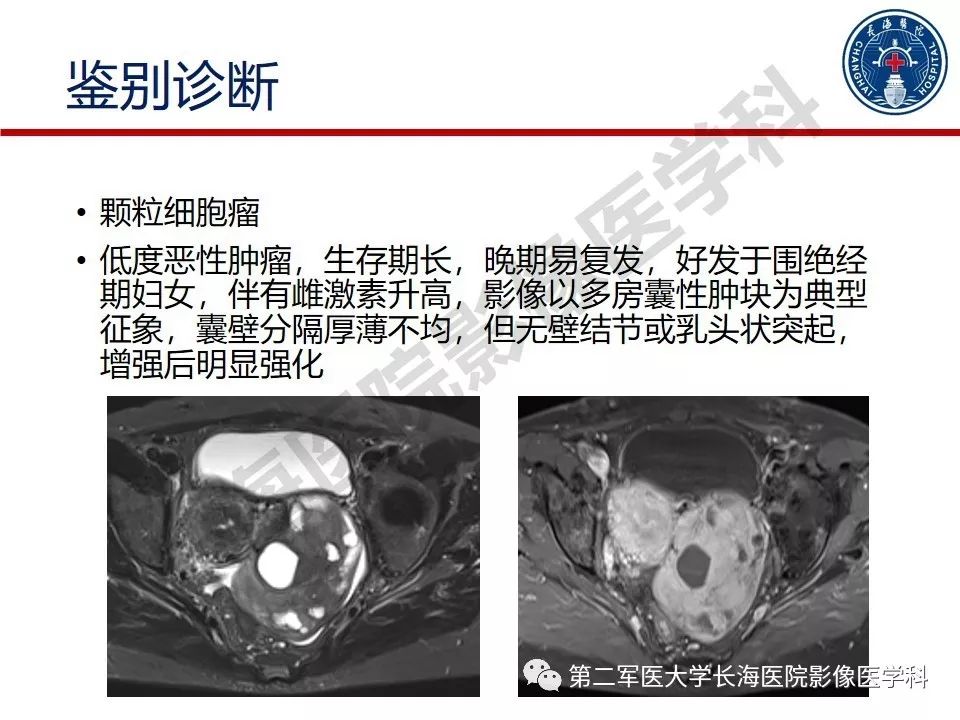 【PPT】纤维-卵泡膜细胞肿瘤影像诊断