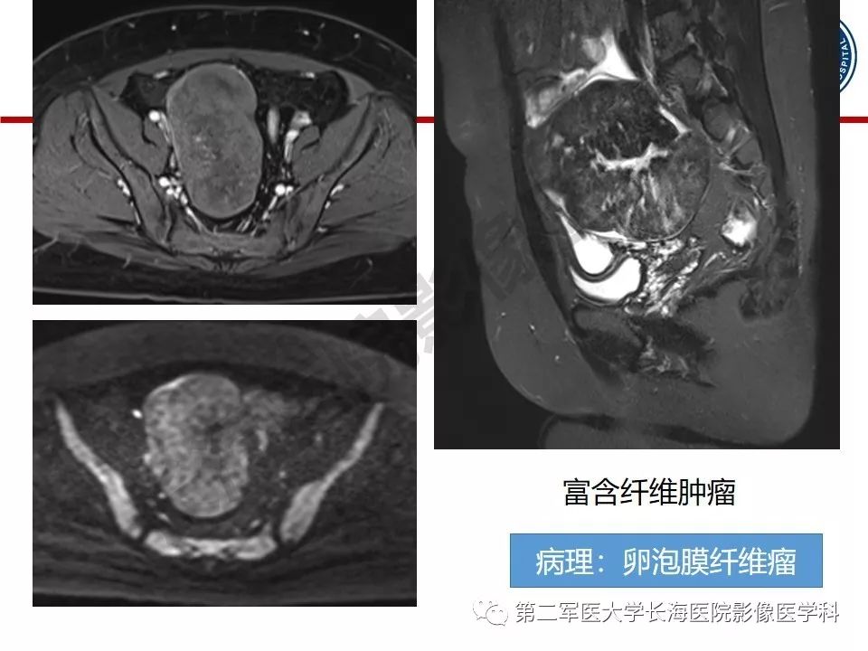 【PPT】纤维-卵泡膜细胞肿瘤影像诊断
