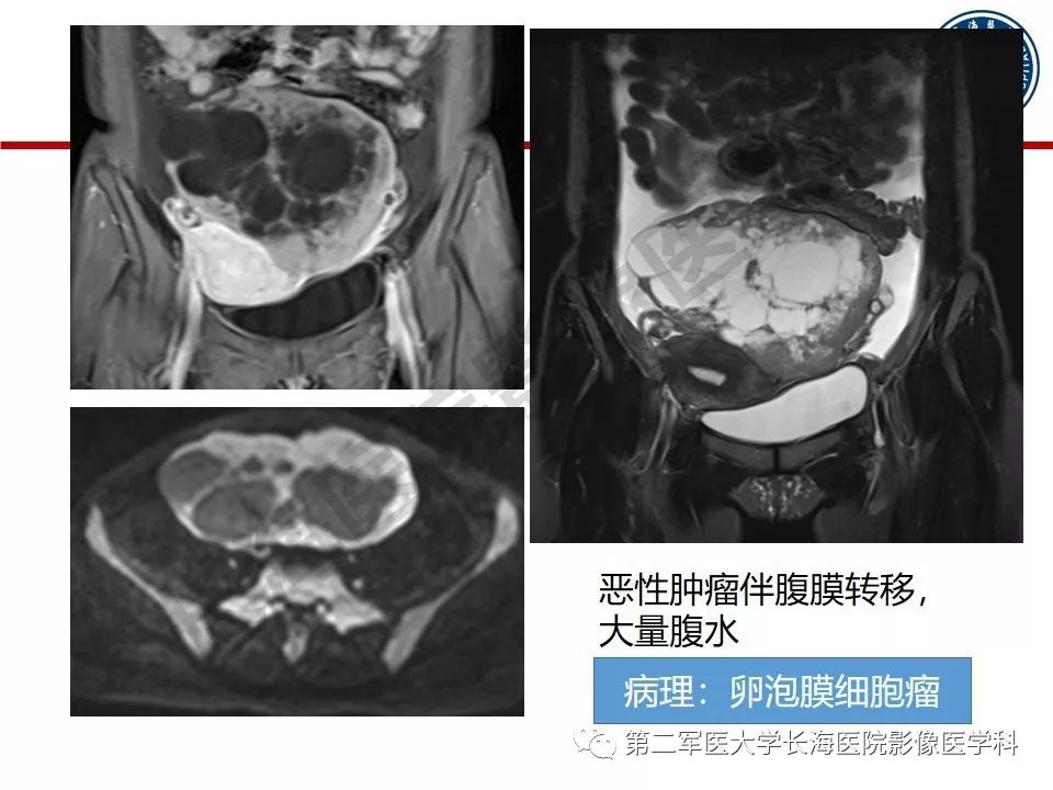 【PPT】纤维-卵泡膜细胞肿瘤影像诊断