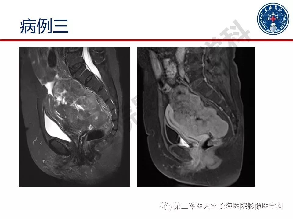 【PPT】纤维-卵泡膜细胞肿瘤影像诊断