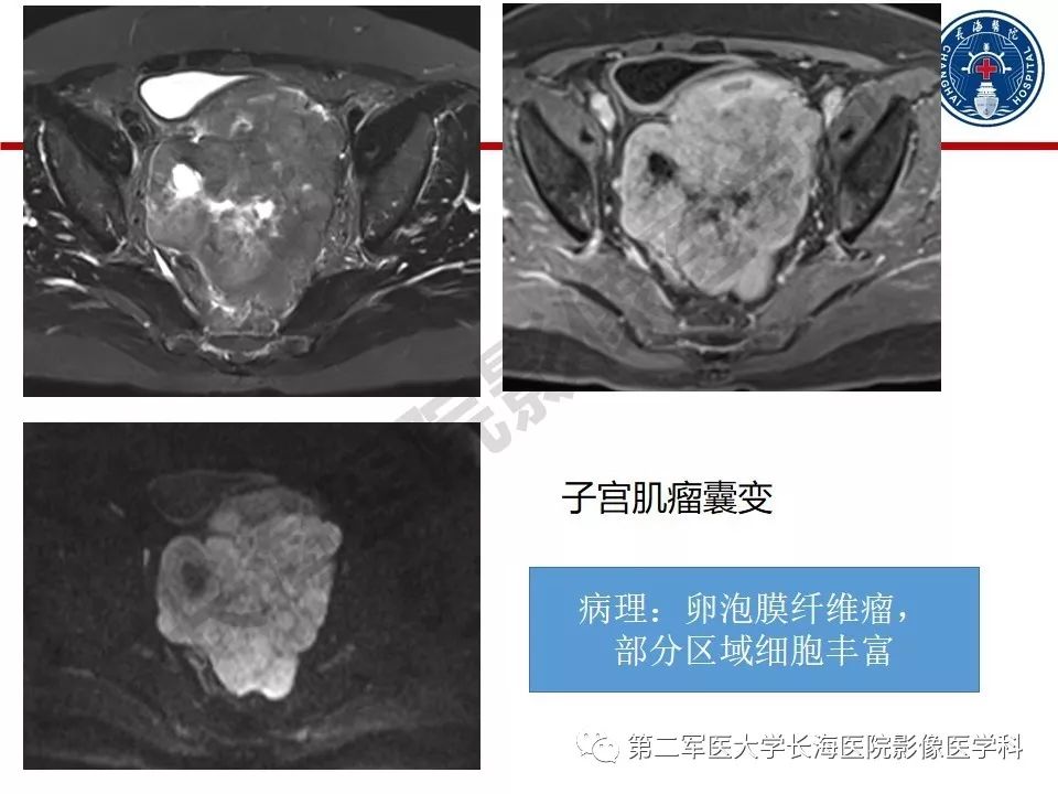 【PPT】纤维-卵泡膜细胞肿瘤影像诊断