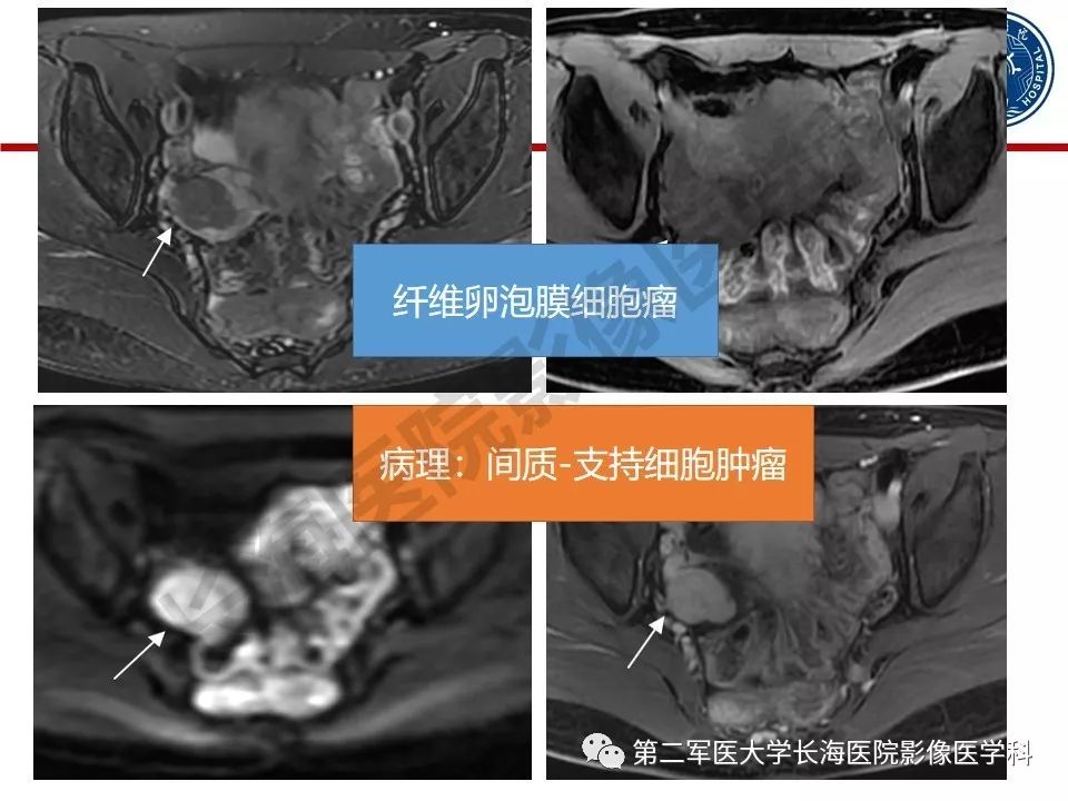 【PPT】纤维-卵泡膜细胞肿瘤影像诊断