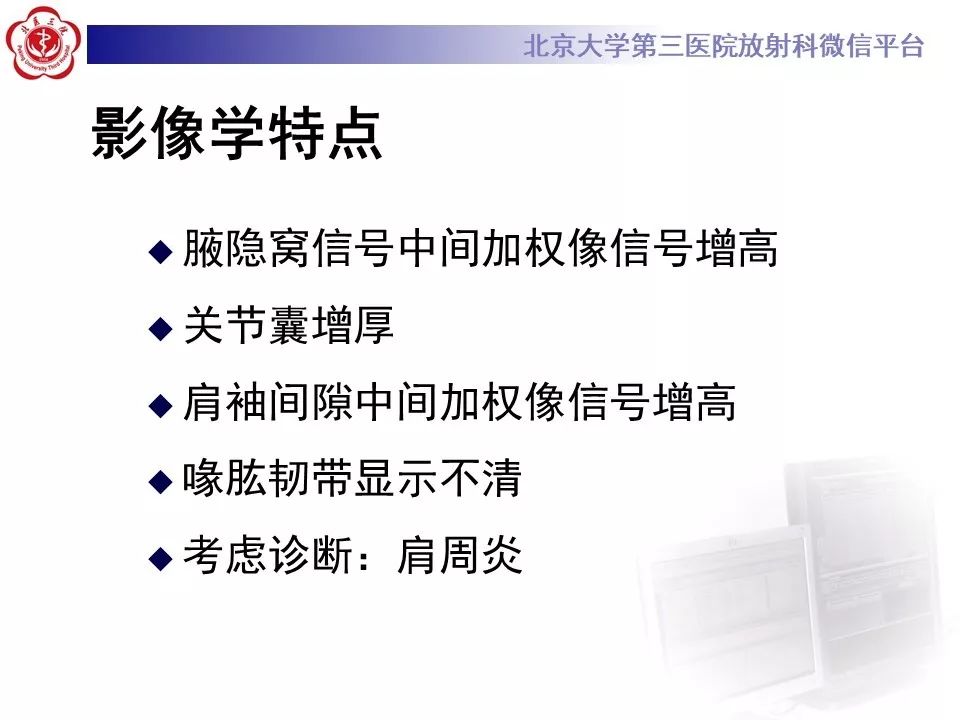 【PPT】肩周炎/粘连性关节囊炎影像表现