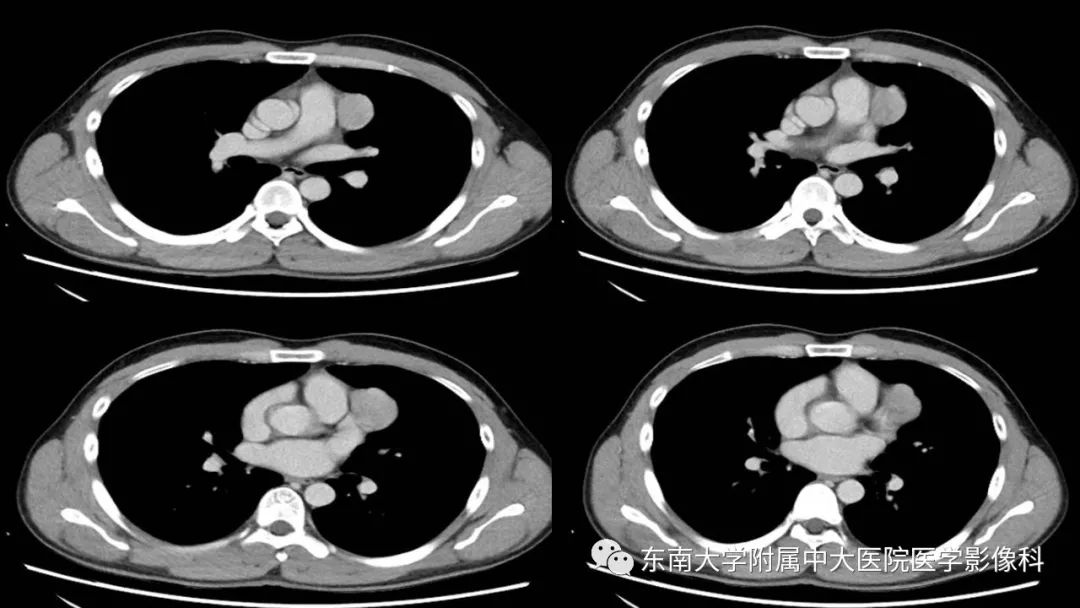 【PPT】胸腺瘤