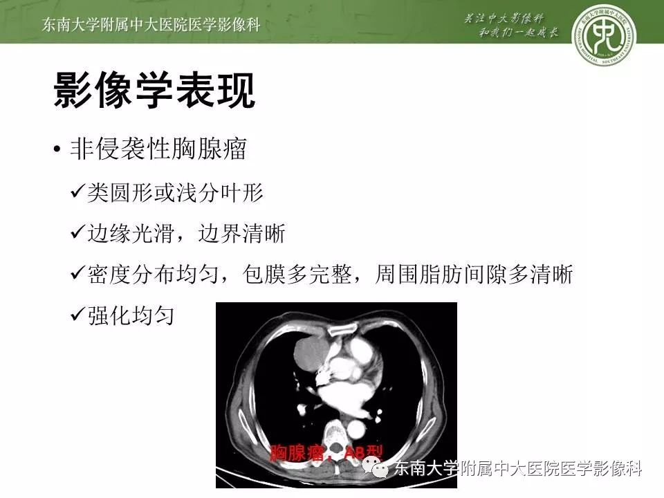 【PPT】胸腺瘤