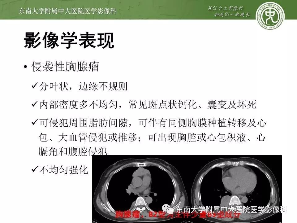【PPT】胸腺瘤