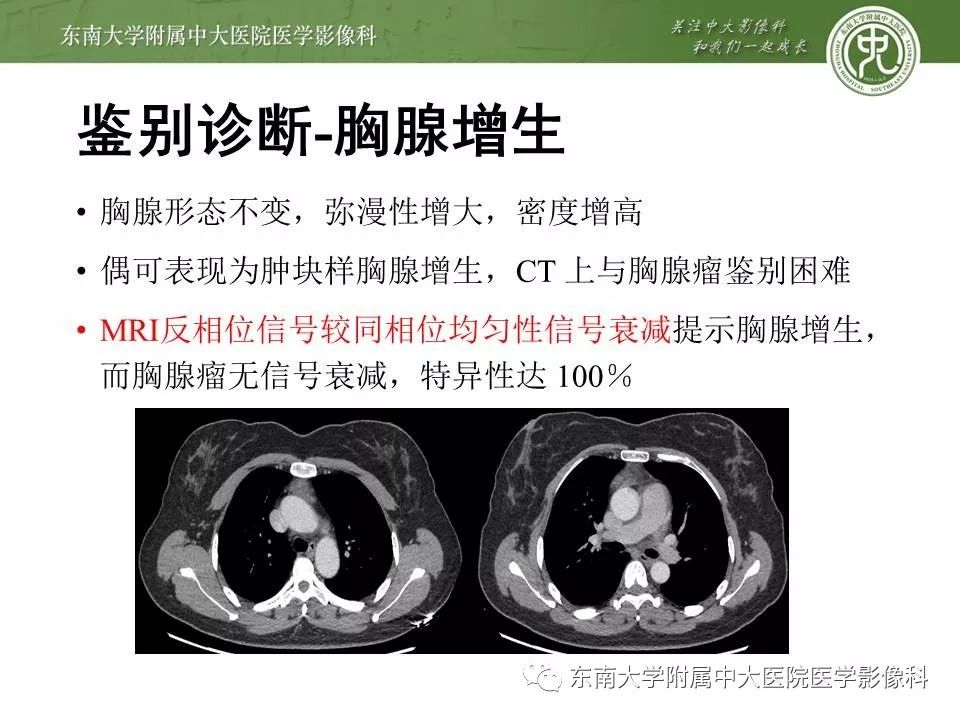 【PPT】胸腺瘤