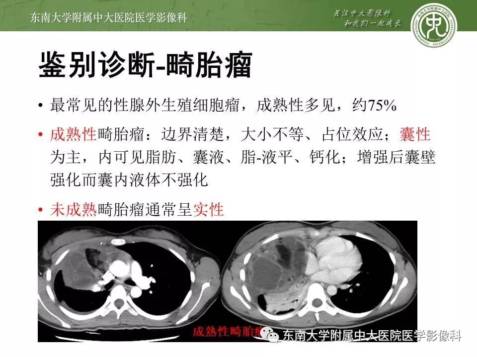 【PPT】胸腺瘤
