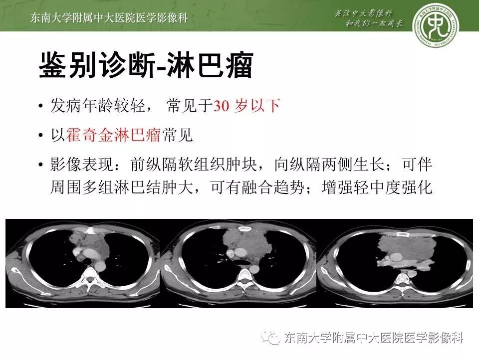 【PPT】胸腺瘤