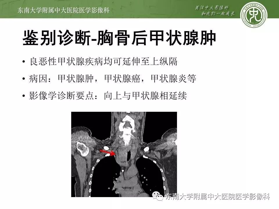 【PPT】胸腺瘤
