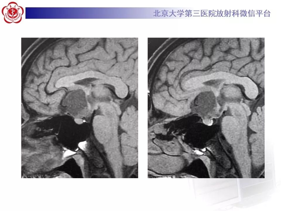 【PPT】颅咽管瘤影像