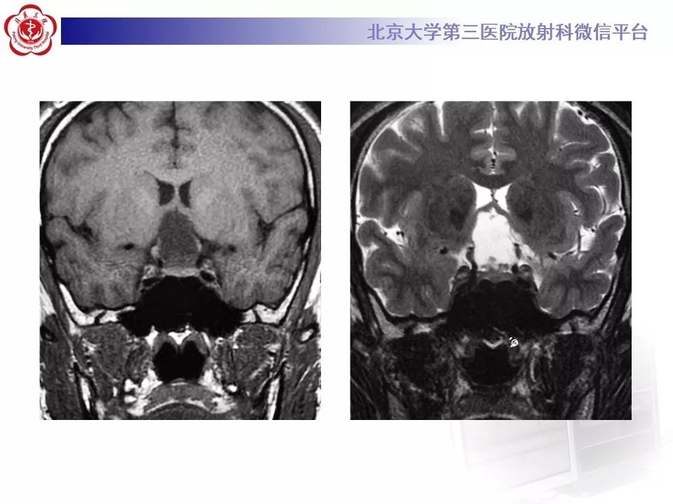【PPT】颅咽管瘤影像
