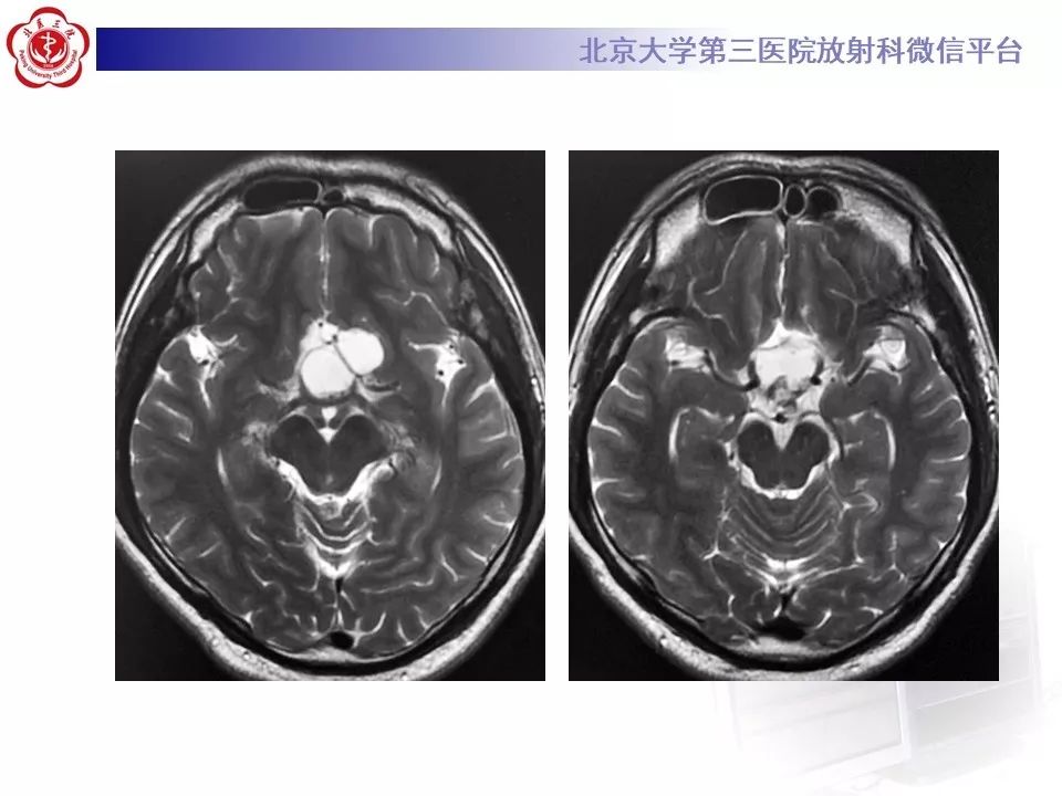 【PPT】颅咽管瘤影像