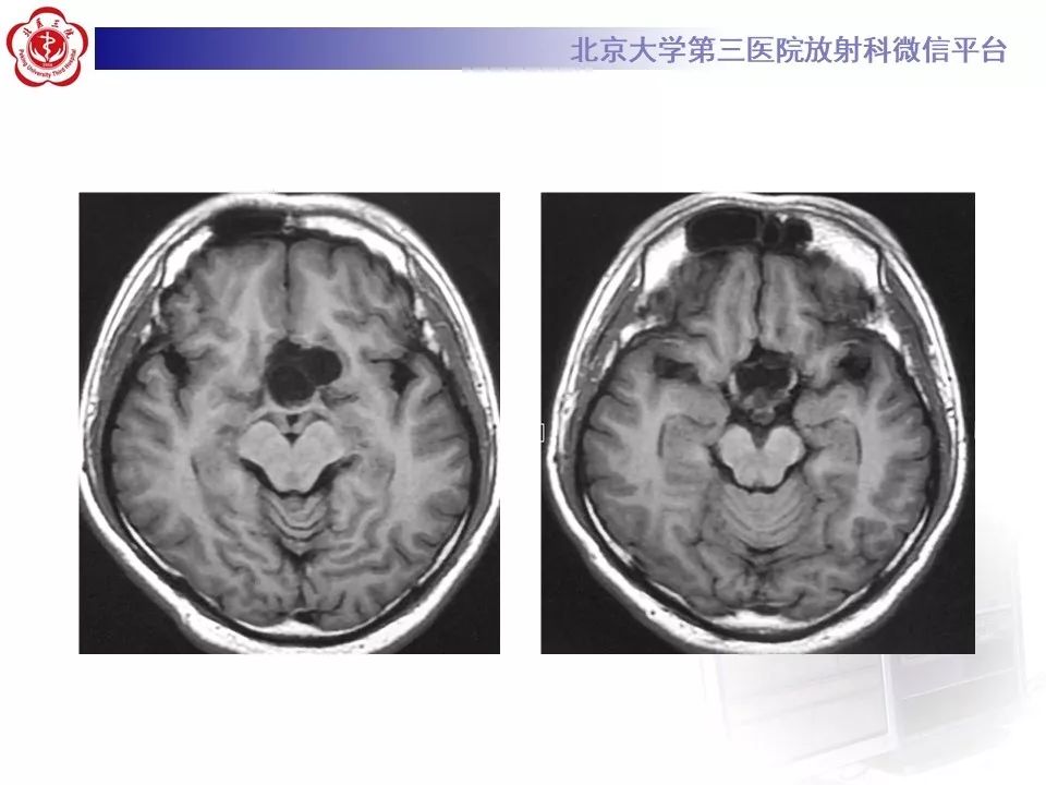 【PPT】颅咽管瘤影像