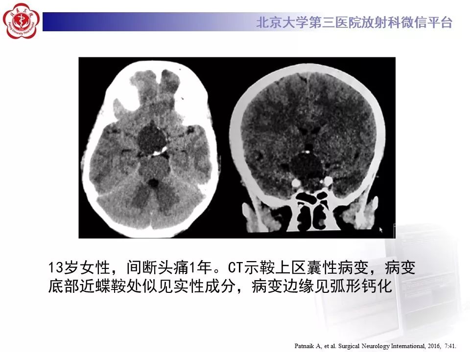【PPT】颅咽管瘤影像