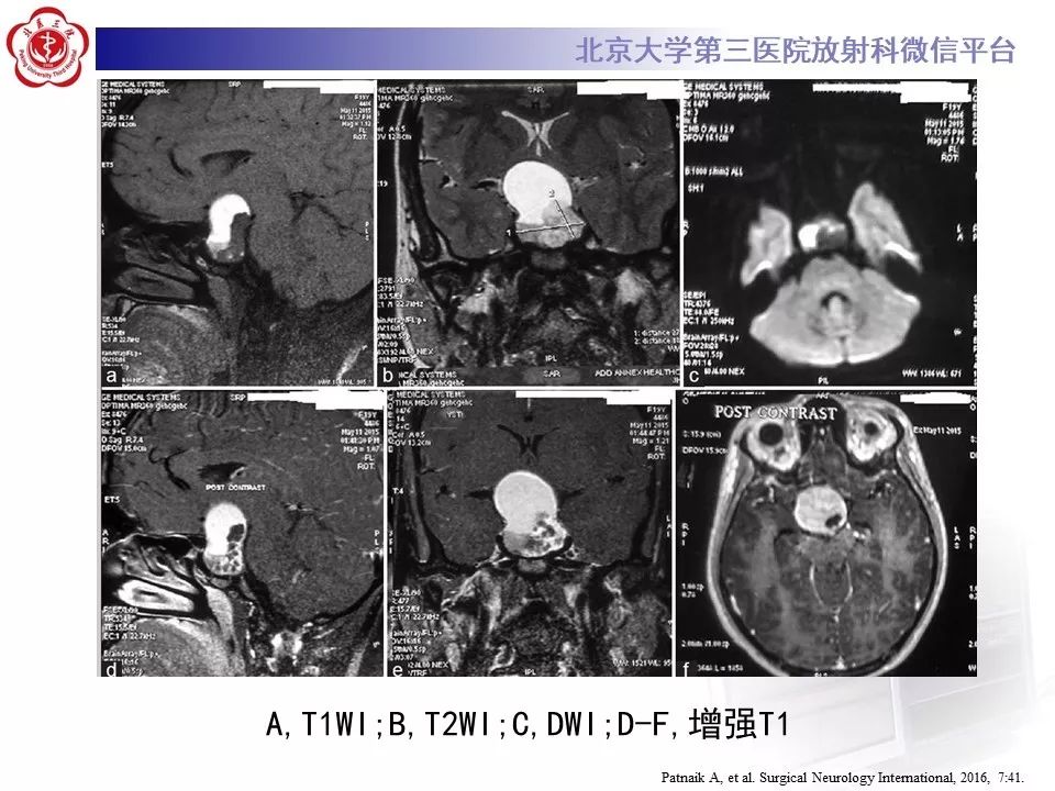 【PPT】颅咽管瘤影像