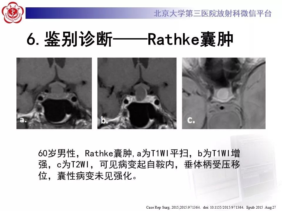 【PPT】颅咽管瘤影像