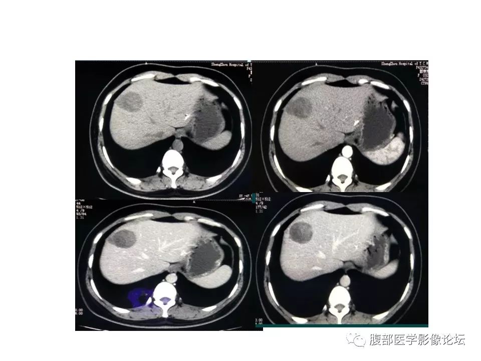 【病例】胰体尾实性假乳头瘤1例CT影像