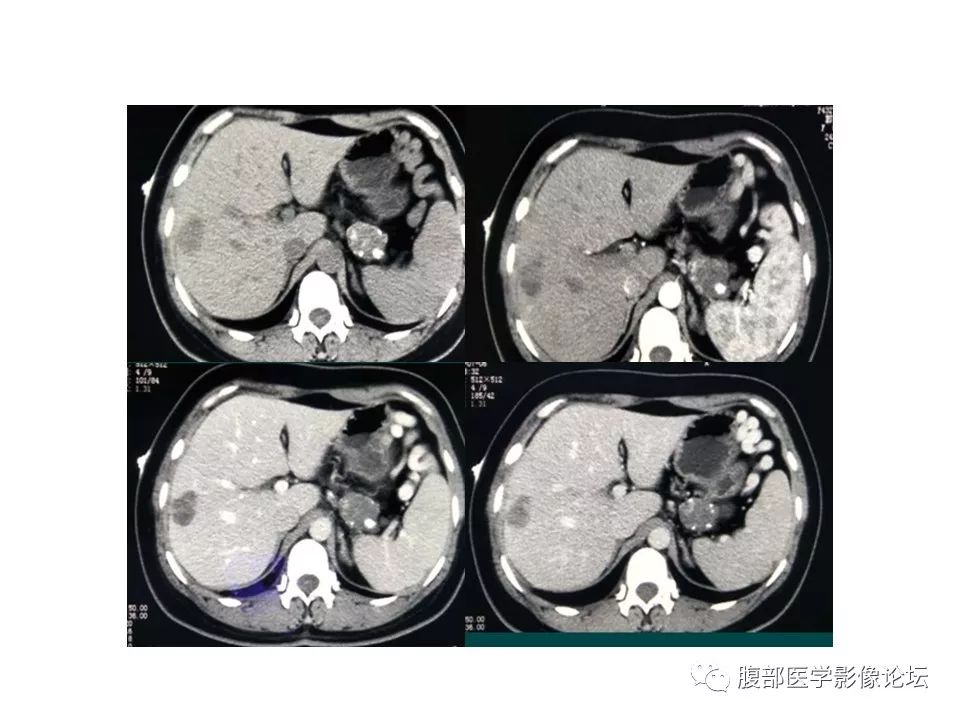 【病例】胰体尾实性假乳头瘤1例CT影像