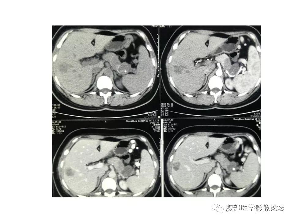 【病例】胰体尾实性假乳头瘤1例CT影像