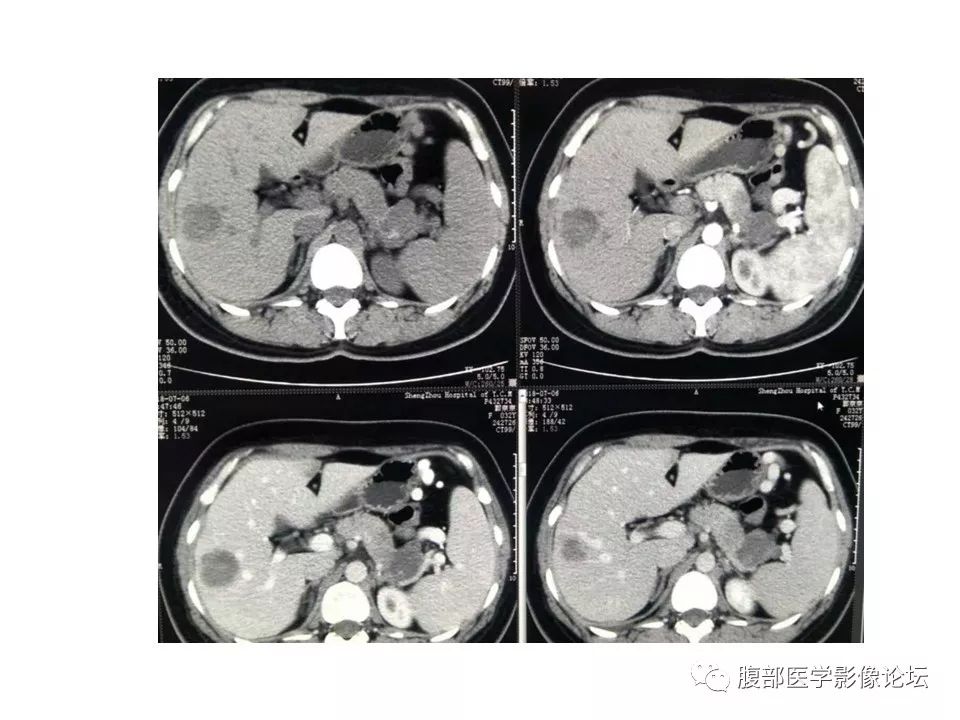 【病例】胰体尾实性假乳头瘤1例CT影像