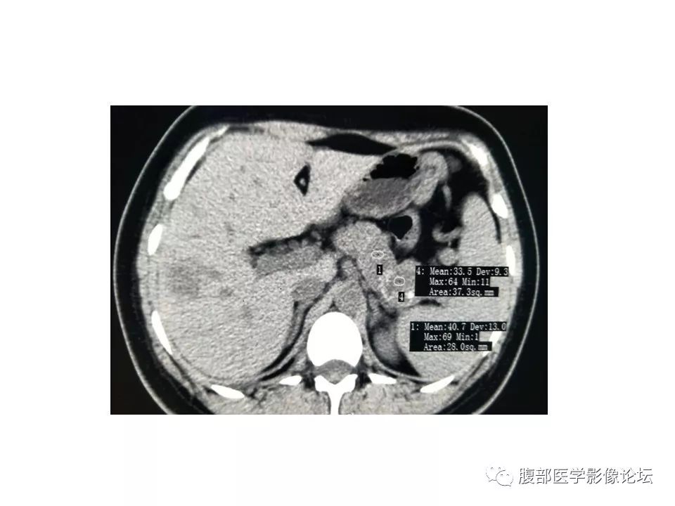 【病例】胰体尾实性假乳头瘤1例CT影像