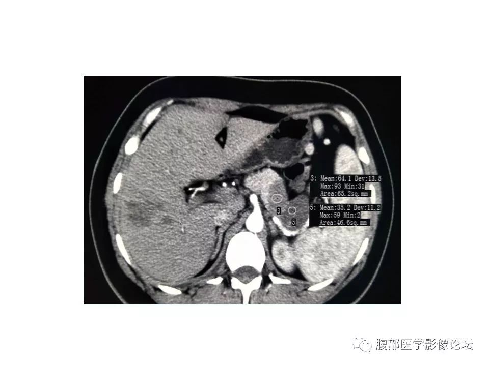 【病例】胰体尾实性假乳头瘤1例CT影像