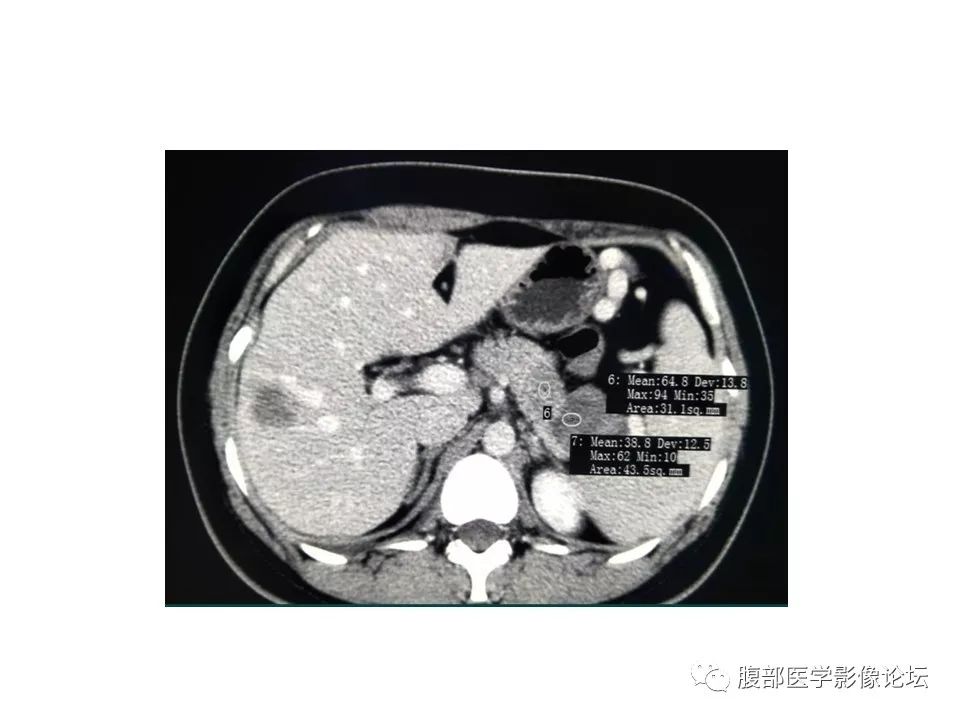 【病例】胰体尾实性假乳头瘤1例CT影像