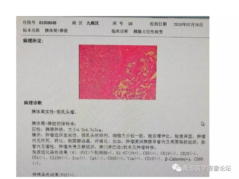 【病例】胰体尾实性假乳头瘤1例CT影像