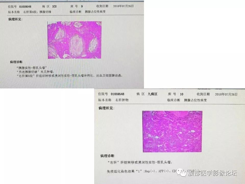 【病例】胰体尾实性假乳头瘤1例CT影像