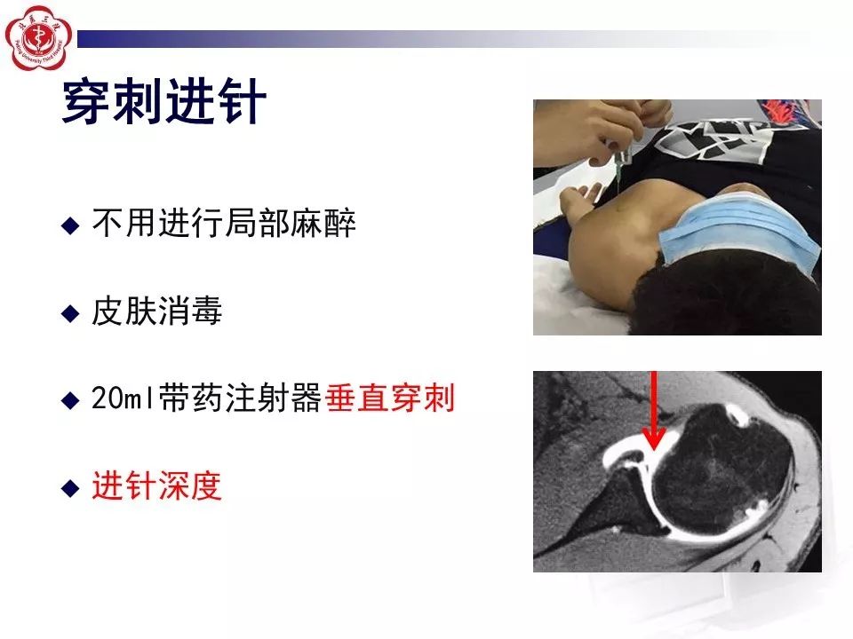 【PPT】肩关节MR造影方法