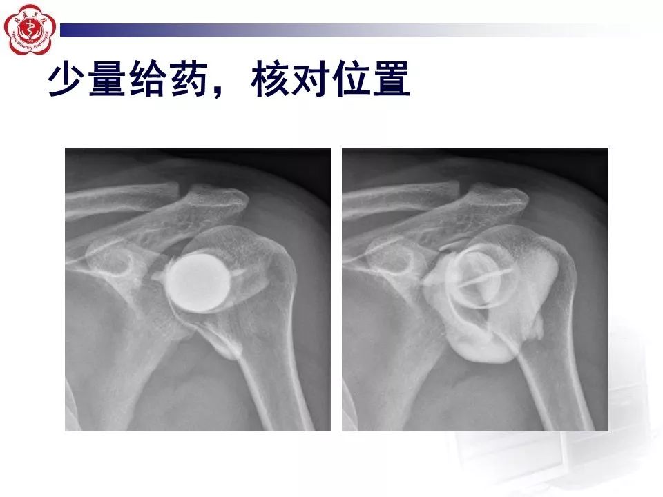 【PPT】肩关节MR造影方法
