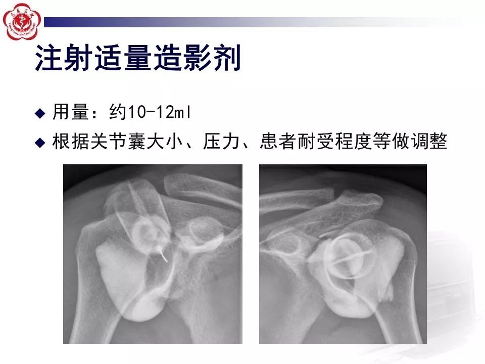 【PPT】肩关节MR造影方法