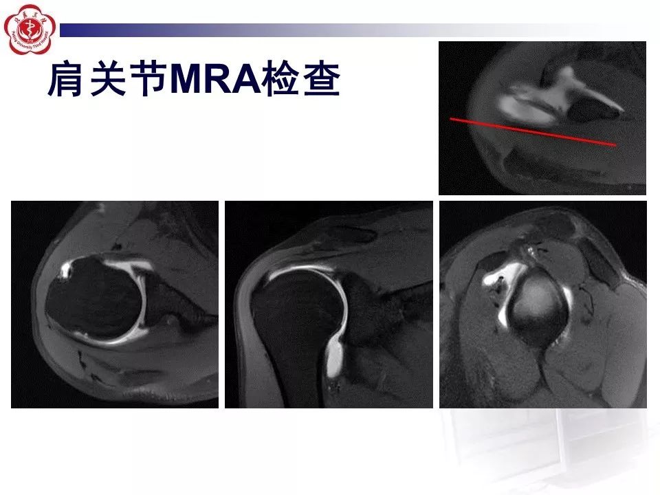 【PPT】肩关节MR造影方法