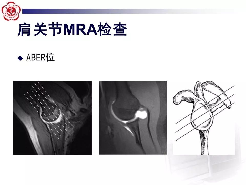 【PPT】肩关节MR造影方法
