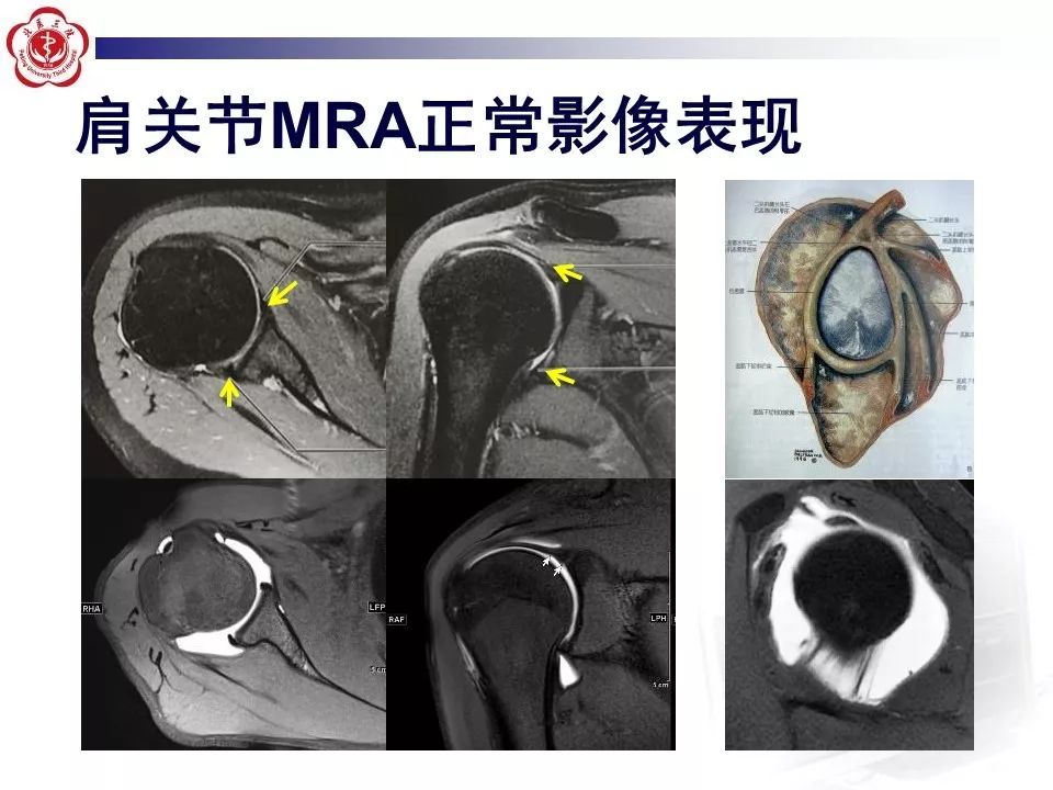【PPT】肩关节MR造影方法