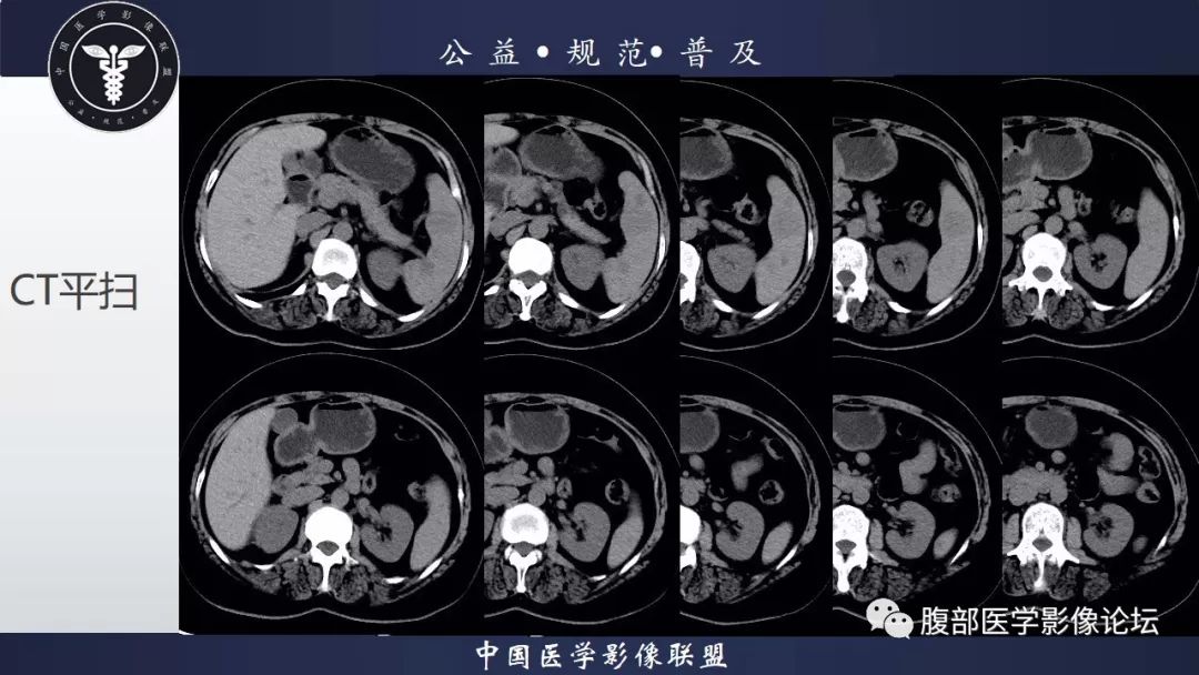 【病例】脾脏窦岸细胞血管瘤三例讨论及文献复习