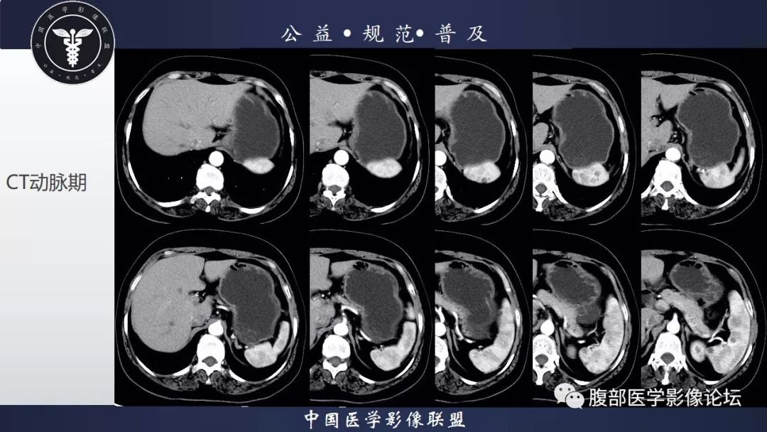 【病例】脾脏窦岸细胞血管瘤三例讨论及文献复习