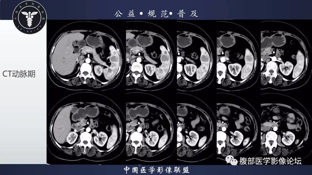 【病例】脾脏窦岸细胞血管瘤三例讨论及文献复习