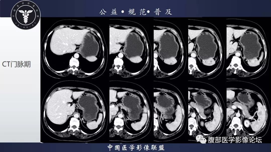 【病例】脾脏窦岸细胞血管瘤三例讨论及文献复习